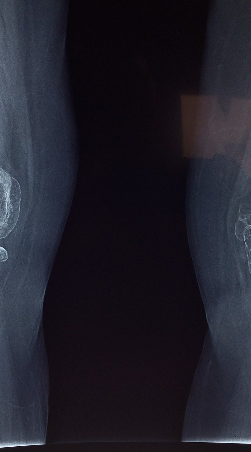 Artroskopia kolana – zabieg konieczny.